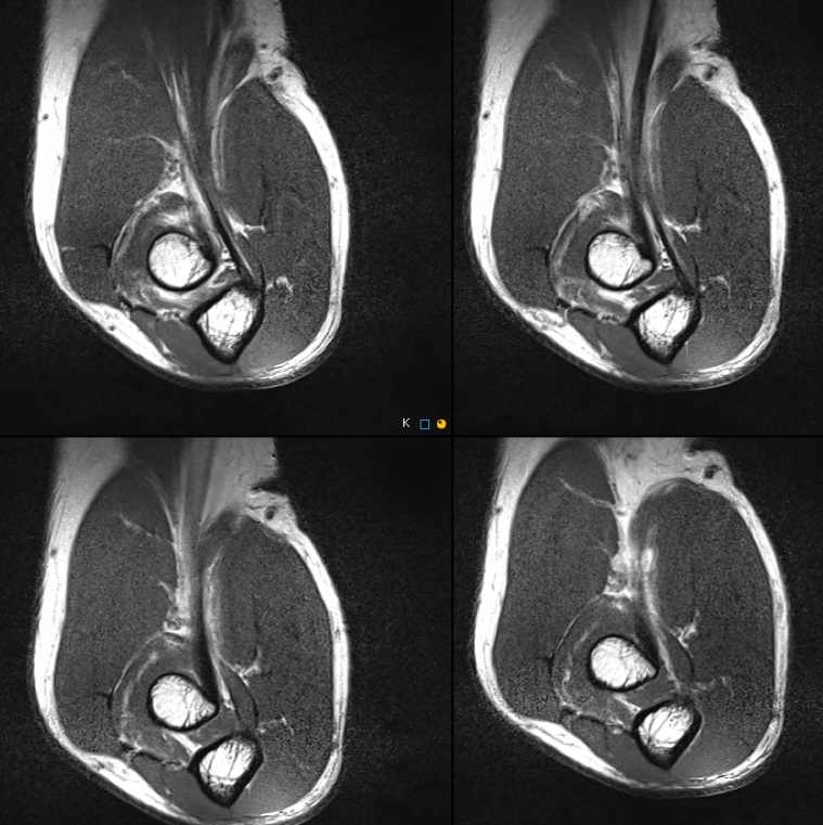Figure 3 for case biceps tendinopathy and partial tear